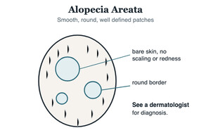 Illustration of round smooth patches of alopecia areata on a scalp outline
