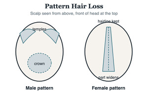 Labeled diagram comparing male pattern hair loss at the temples and crown with female pattern widening of the part